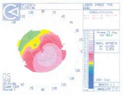 Corneal topography from 1996 shows the patient’s left eye prior to treatment; extremely steep cornea